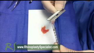 Rhinoplasty Surgical Technique Diced Cartilage [upl. by Haines]