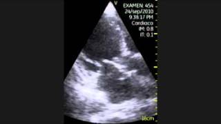 VSCAN Aortic endocarditis Endocarditis aórtica y port a cath Pocket Ultrasound [upl. by Odlonra680]