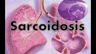 Sarcoidosis  sarcoidosis lung disease  sarcoidosis treatment  sarcoidosis radiology  symptoms [upl. by Gnouh574]