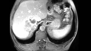 Retroperitoneal Liposarcoma [upl. by Orth]