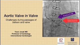 Aortic valve in valve with Evolut R wire selection [upl. by Leler]