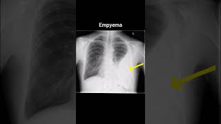 Empyema xray radiology röntgen thorax empyema [upl. by Joell506]