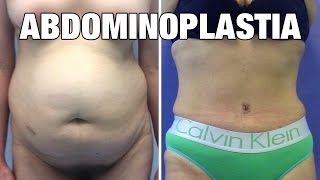 Abdominoplastia en Mujeres  Antes y después  Experiencia Flor [upl. by Sulohcin]