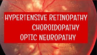 HYPERTENSIVE RETINOPATHY  pathology and signs [upl. by Hnah]