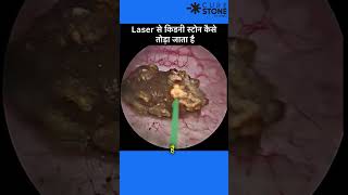 23 mm Kidney Stone treatment  RIRS  Retrograde intrarenal surgery shorts [upl. by Soirtimid]