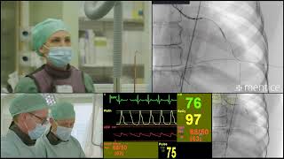 Interventional Cardiology  Left main PCI perforation complication management  VR simulation [upl. by Imeka]