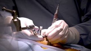 Minimally Invasive Laminectomy Surgery to Treat Lumbar Stenosis  MedStar Southern Maryland [upl. by Aleras]