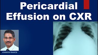 Pericardial Effusion on CXR [upl. by Eiryk]