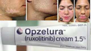 Opzelura ruxolitinib cream [upl. by Edward]