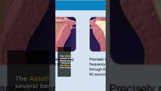 Painless Pulmonary Vein Isolation Your Ultimate Guide to Atrial Fibrillation Ablation [upl. by Buote]