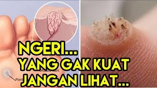 Cara Mengatasi Mata Ikan Dengan Cepat Dan Aman [upl. by Aramen]