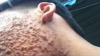 Big Cystic Acne Blackheads Extraction Blackheads amp Milia Whiteheads Removal Pimple Popping [upl. by Kilam526]