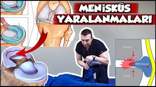 Menisküs Yırtığı  Menisküs Ameliyatsız Tedavi ve Menisküs Diz Egzersizleri [upl. by Hump]