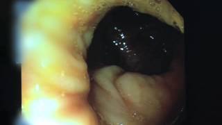 Video of a Colonoscopy [upl. by Annoik]