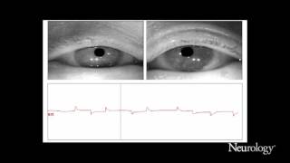 Alternating horizontal single saccadic pulses in progressive supranuclear palsy [upl. by Alcinia248]