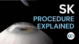 Superficial Keratectomy SK Procedure Explained  Precision Cornea Centre [upl. by Avra]