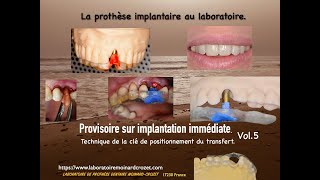 Provisoire sur implantation immédiate quotTechnique de la clé de positionnement du transfertquotvol5 [upl. by Martine]