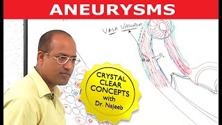 Aneurysms  Causes and Symptoms  Cardiology [upl. by Zacarias379]