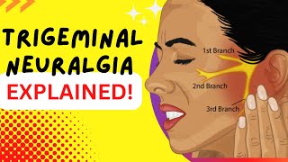 Trigeminal Neuralgia  Explained  Worlds most painful disease Causes and Treatment [upl. by Idnar]