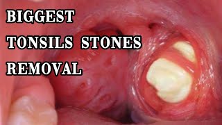 biggest tonsils stones removal tonsilolith hidden huge tonsils stones removal [upl. by Muna]