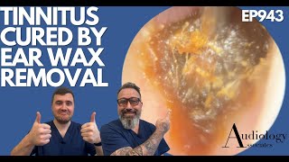 TINNITUS CURED BY EAR WAX REMOVAL  EP943 [upl. by Opaline]