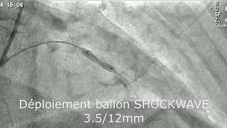 iva moy calcifiée shockwave [upl. by Lebanna]