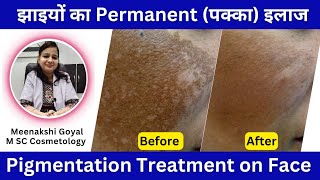 Pigmentation Treatment on Face  Hyperpigmentation Treatment [upl. by Enalahs]