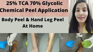 25 TCA 70 Glycolic Chemical Peel Application At Home Hand Leg chemical peel at Home  in Hindi [upl. by Wulfe]