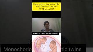 monochorionoc Diamniotic twins pregnancy me delivery ka sahi time kya hota h shortstwinsdelivery [upl. by Raseta346]