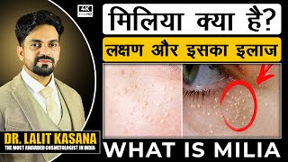 WHAT IS MILIA  मिलिया क्या है लक्षण और इसका इलाज DR LALIT KASANA [upl. by Bibbie438]