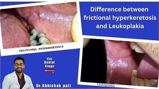 DIFFERENCE BETWEEN FRICTIONAL HYPERKERATOSIS AND LEUKOPLAKIA [upl. by Marlene]