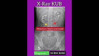 Medullary Nephrocalcinosis  Diagnosis   X Ray KUB  Radiology [upl. by Abshier]