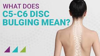 What Does C5C6 Disc Bulging Mean [upl. by Nirre]