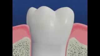 Periodontal Disease amp Treatment [upl. by Shirah221]