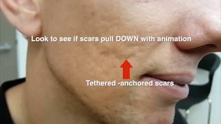 ACNE SCARS  subcision [upl. by Hallerson287]