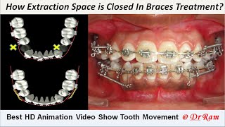 How Extracted Premolars Space is Closed by Braces Best Animation to Know Sliding Mechanics Dr Ram [upl. by Ettennaej]