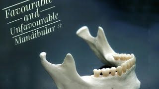 Mandibular Fractures  Favourable and Unfavourable [upl. by Aliemaj]