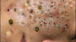 Huge blackhead removal from face  blackheads new this week 2024 [upl. by Norrahs]