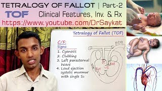 Tetralogy of Fallot TOF  Part 2  Clinical features Investigations amp Treatment  Dr Saykat [upl. by Ailama]