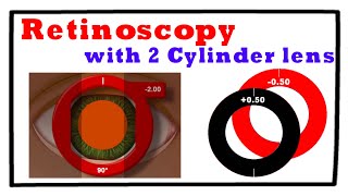 Retinoscopy with 2 Cylinder Trial Lenses Technique 3 [upl. by Arraeit]