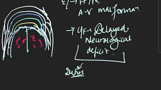 intraparenchymal hematoma  Surgery [upl. by Ahsiruam]