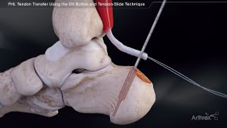 FHL Tendon Transfer Using the DX Button and TensionSlide Technique [upl. by Isbella]