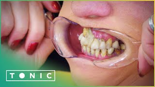 Woman Glues Her Teeth Back In Place To Avoid The Dentist  The Truth About Your Teeth  Tonic [upl. by Etnaik]