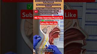 NG Tube Insertion Procedure Emergency icu pharmacynursingdoctor [upl. by Allain]