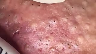 Blackheads amp Whiteheads Satisfying Removal 0275 [upl. by Sidonie]