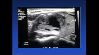 2015 AOCR Radiology Case Review Thyroid Ultrasound [upl. by Leler323]