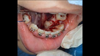 surgical extraction of deep lingually impacted lower 5 [upl. by Lyons]