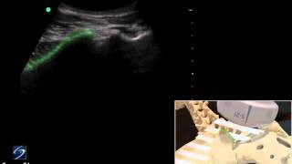 How To Ultrasound Guided Sacroiliac Injection  Sonosite Ultrasound 3D Video [upl. by Aneleve]