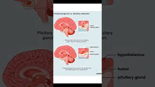 ANSWER IN COMMENTS Lesions of the optic pathway Craniopharyngioma Pituitary adenoma neet neetpg [upl. by Reamonn]