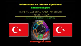 Ekokardiyografi  İnferolateral Ve İnferior Hipokinezi [upl. by Ahcsatan558]